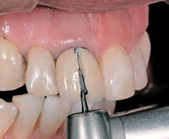 Luxatemp PLUS - снятие постоянной коронки